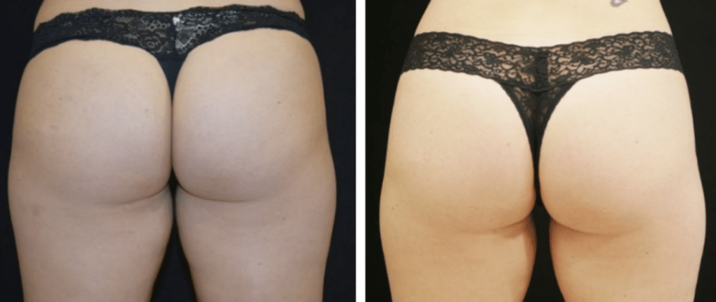 Non-Invasive Body Sculpting Treatment before and after photo